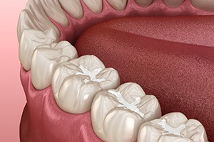 Illustration showing tooth-colored fillings on chewing surfaces of teeth