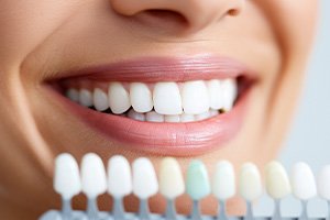 Woman’s smile next to dental shade guide