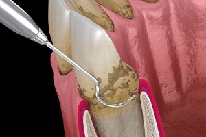 Illustration of dental scaler cleaning tooth roots