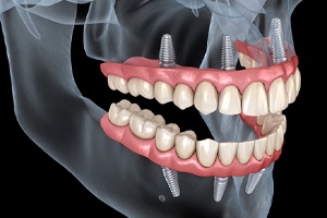 Illustration of All-on-4 dental implants for upper and lower arches