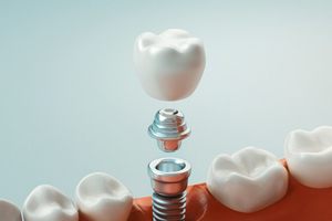 Illustration of traditional dental implant, abutment, and crown