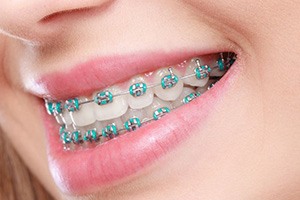 Close-up of woman’s smile with braces