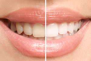 Smile before and after teeth whitening