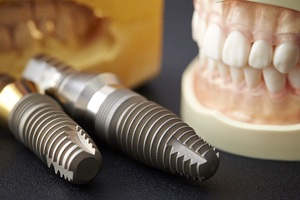 Two enlarged dental implants next to dental model