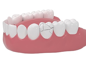 Illustration of badly cracked tooth that may need to be extracted