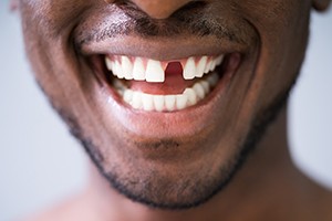 Man’s cheerful smile after tooth extraction