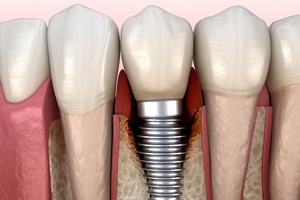 Illustration of peri-implantitis, a cause of dental implant failure