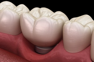 Gum recession around dental implant, a sign of implant failure