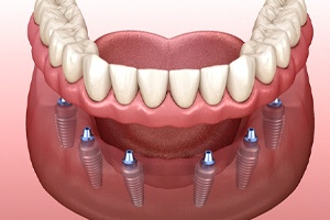 Implant denture on reflective surface, next to mirror