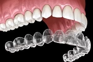 Illustration of clear aligner being placed on upper arch