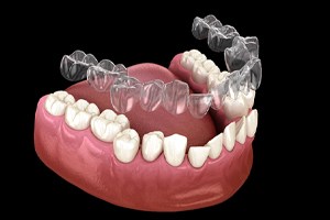 Illustration of aligner being placed on misaligned teeth (indications h2)