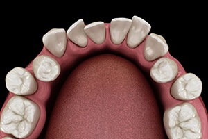 Illustration of crowded, overlapping teeth