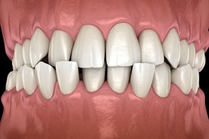 Illustration of upper and lower teeth with crossbite