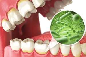 Illustration showing the bacteria that causes gum disease