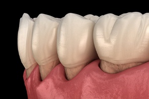 Illustration of receding gums, a symptom of gum disease