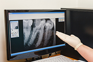 Digital dental x-rays on chairside computer