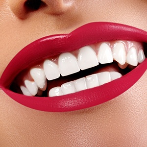 Close-up of woman’s smile with veneers in Needham