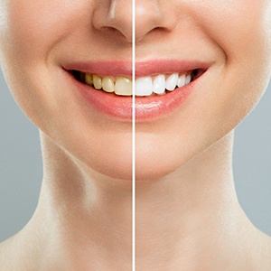 Woman’s smile before and after professional teeth whitening in Needham