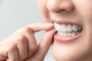 Close-up of woman’s teeth with Invisalign aligner