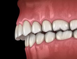 Detailed illustration of an overbite against a dark background
