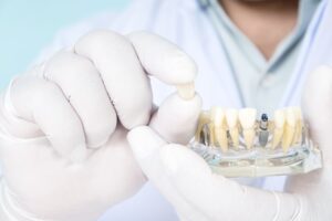 Gloved hands holding dental implant model