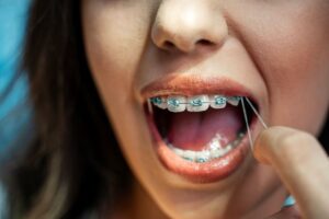 Woman placing rubber bands on her braces 